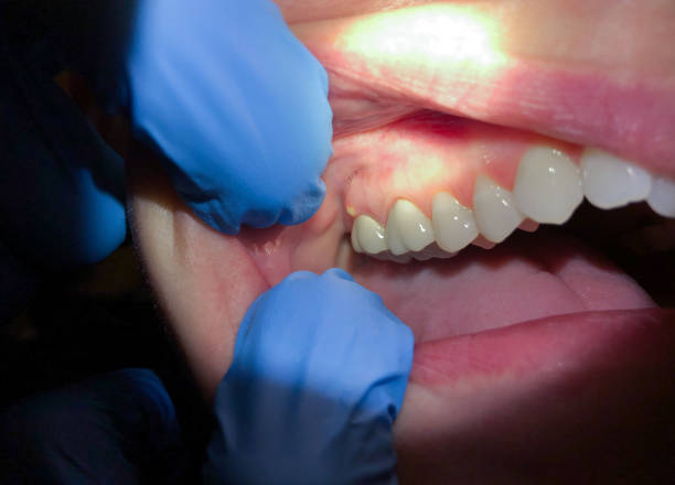 Best Emergency Treatment for Dental Infections or Abscesses in Fort Carson, CO