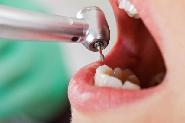 Best Emergency Tooth Extraction in Fort Carson, CO